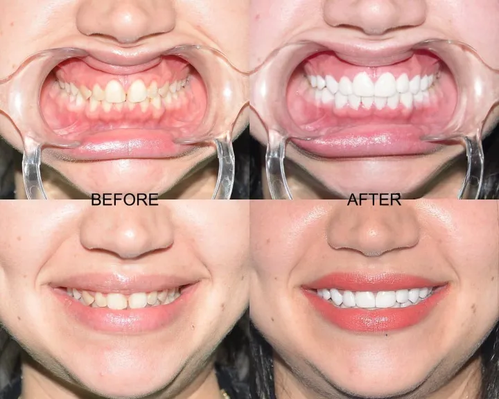 Blanchiment professionnel