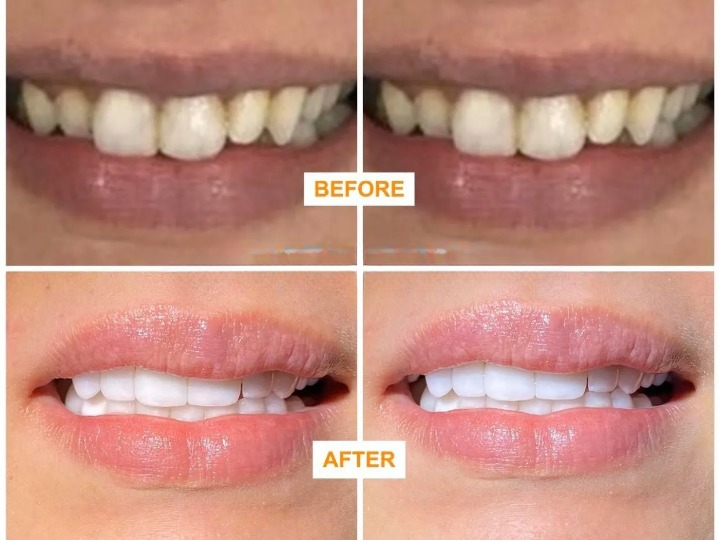 Facettes porcelaine ultra-fines